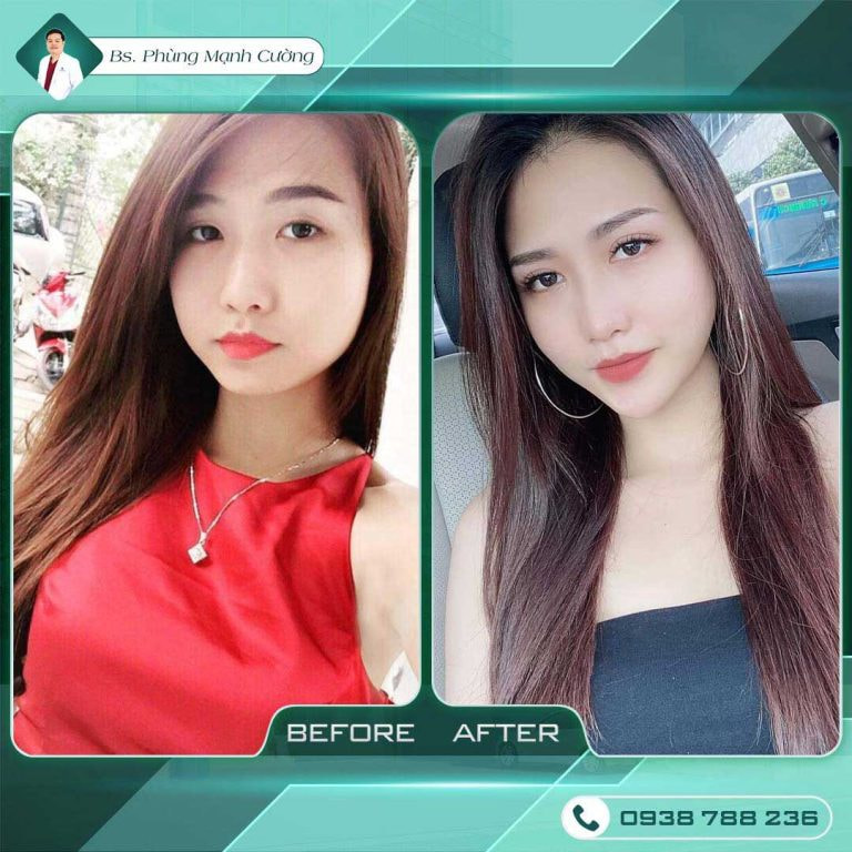 Cắt mí mắt Eyelid - Công nghệ plasma vết thương nhanh hồi phục