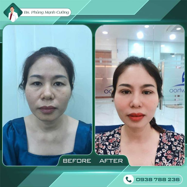 Cắt mí mắt dưới Perfect - Khắc phục các mí mắt hỏng