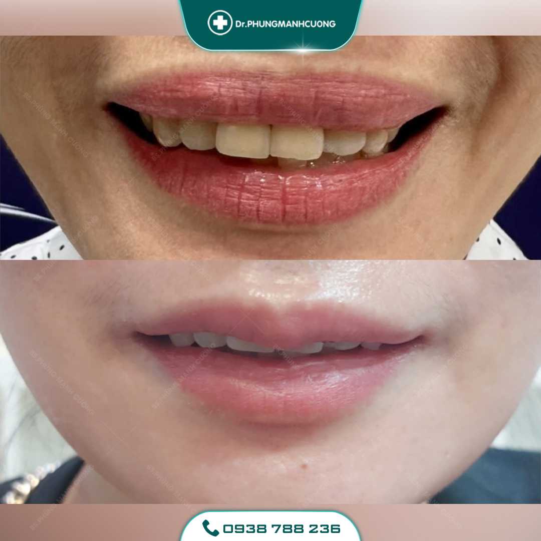 Tạo Khóe Môi Cười Làm Khuôn Mặt Luôn Tươi Tắn Rạng Ngời 27 mm 1