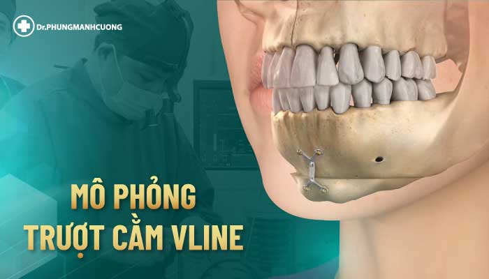 Phẫu Thuật Trượt Cằm V Line