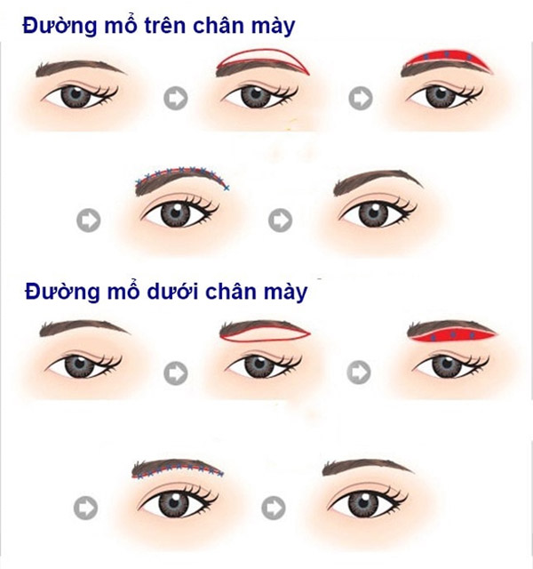 Nâng Cung Chân Mày Nội Soi Là Gì?