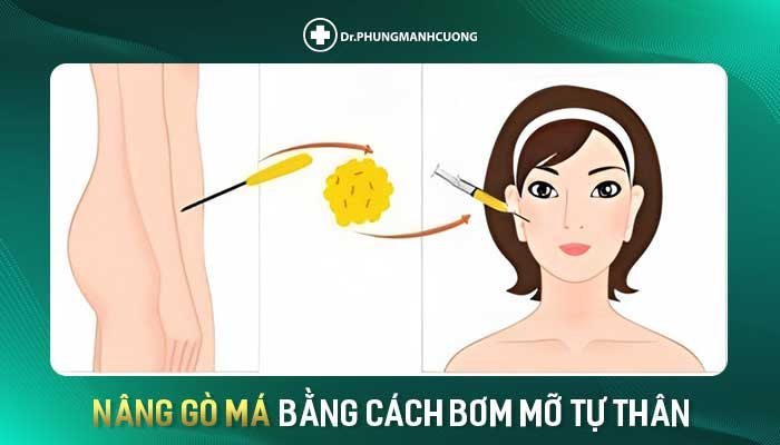 Phẫu Thuật Nâng Gò Má - Tôn Tạo Khuôn Mặt Hài Hòa Cân Đối 14 Nâng gò má bằng cách bơm mỡ tự thân
