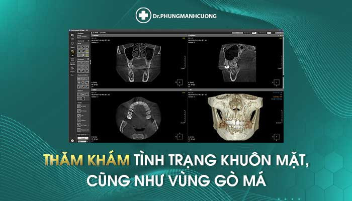 Phẫu Thuật Nâng Gò Má - Tôn Tạo Khuôn Mặt Hài Hòa Cân Đối 15 Thăm khám khuôn mặt trước khi thực hiện nâng gò má