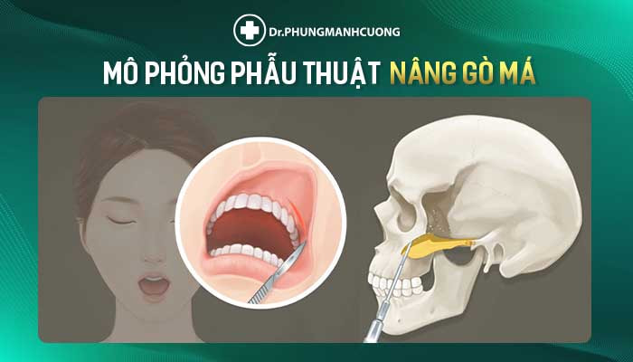 Phẫu Thuật Nâng Gò Má - Tôn Tạo Khuôn Mặt Hài Hòa Cân Đối 12 Mô phỏng phẫu thuật nâng gò má tại BS Phùng Mạnh Cường