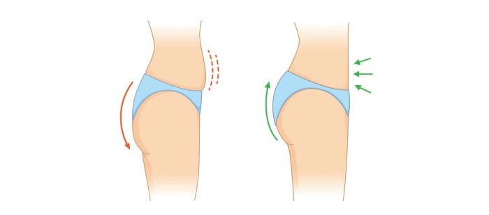 Nâng Mông Bằng Mỡ Tự Thân Cho Vòng 3 Căng Đầy, Mềm Mại 11 Nâng Mông Bằng Mỡ Tự Thân Cho Vòng 3 Căng Đầy, Mềm Mại