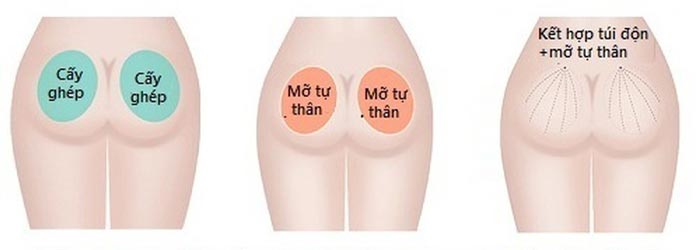 Nâng Mông Bằng Mỡ Tự Thân Cho Vòng 3 Căng Đầy, Mềm Mại 13 Điểm khác nhau giữa 2 phương pháp nâng mông