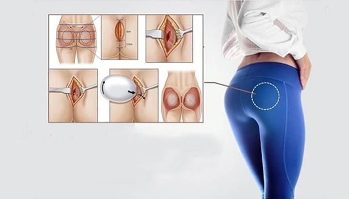 Nâng Mông Nội Soi - Tạo Hình Vòng 3 Gợi Cảm, Đẹp Tự Nhiên 11 Nâng Mông Nội Soi Tạo Hình Vòng 3 Gợi Cảm