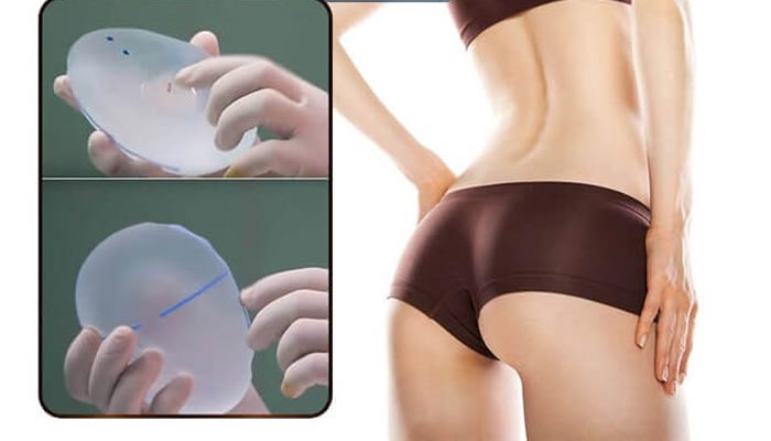 Nâng Mông Nội Soi - Tạo Hình Vòng 3 Gợi Cảm, Đẹp Tự Nhiên 12 Nâng Mông Nội Soi Giúp Chị Em Sở Hữu Được Cặp Mông đẹp gợi cảm