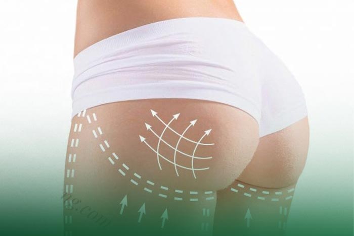 Nâng Mông Nội Soi Bằng Túi Ergonomix Khắc Phục Vòng 3 Chảy Xệ 8 nang mong noi soi bang tui ergonomix 4