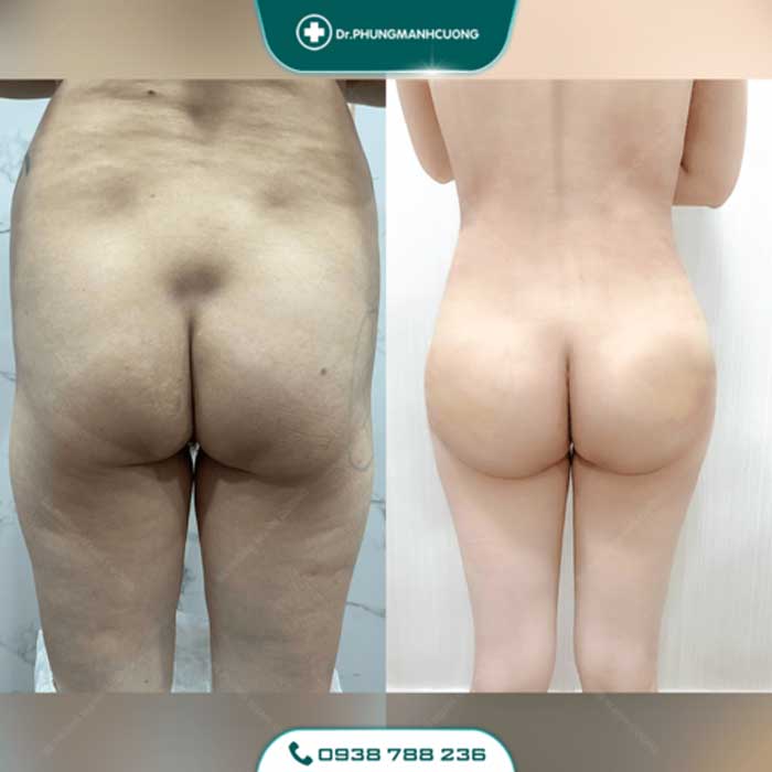 Nâng Mông Nội Soi - Tạo Hình Vòng 3 Gợi Cảm, Đẹp Tự Nhiên 15 nang mong