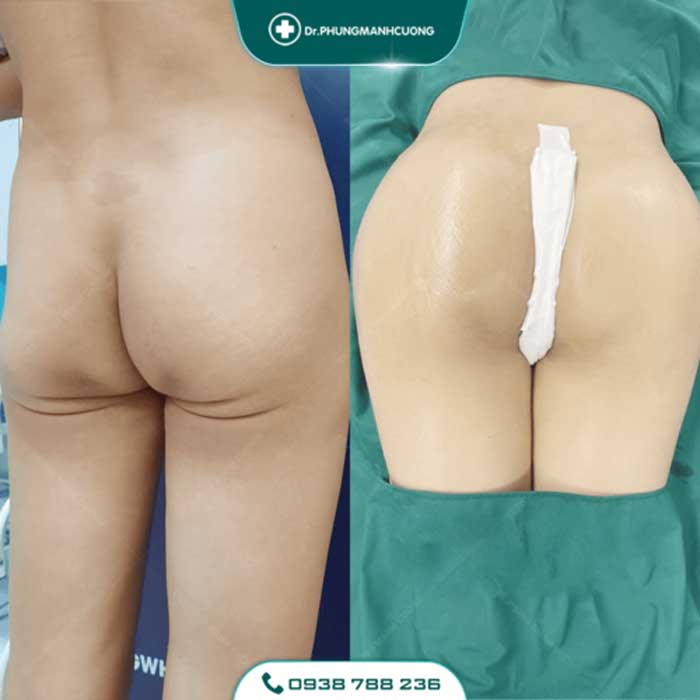 Nâng Mông Nội Soi - Tạo Hình Vòng 3 Gợi Cảm, Đẹp Tự Nhiên 17 nang mong2