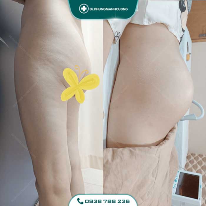 Nâng Mông Nội Soi - Tạo Hình Vòng 3 Gợi Cảm, Đẹp Tự Nhiên 16 nang mong3