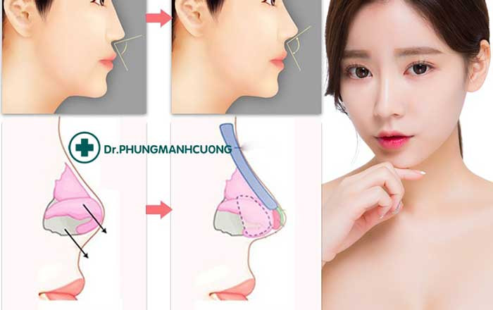 Quy trình Nâng mũi bọc sụn