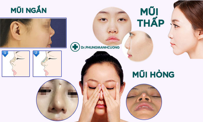 Những đối tượng nên thực hiện nâng mũi bọc sụn