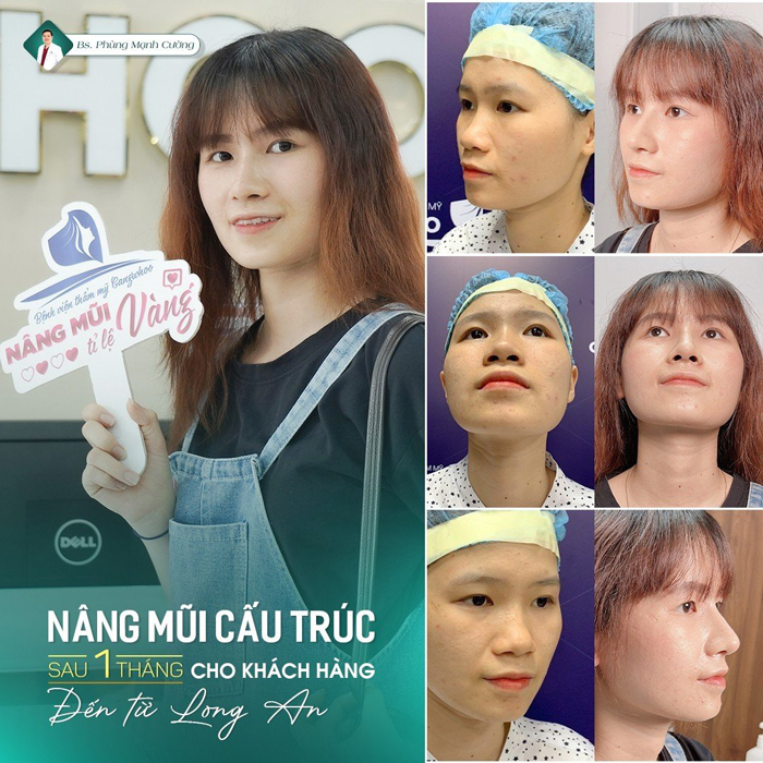 Hình ảnh khách hàng nâng mũi cấu trúc sau 1 tháng
