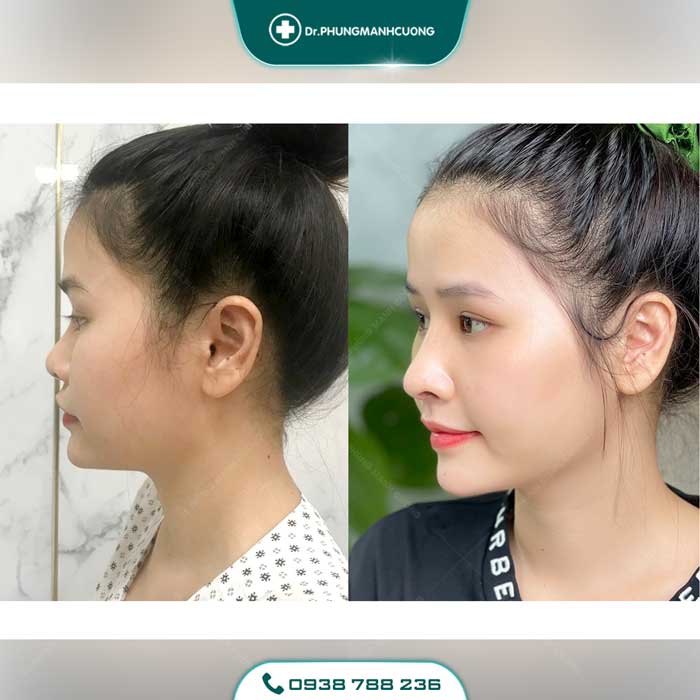 Phương pháp nâng mũi sụn sườn có nhiều ưu điểm nổi bật