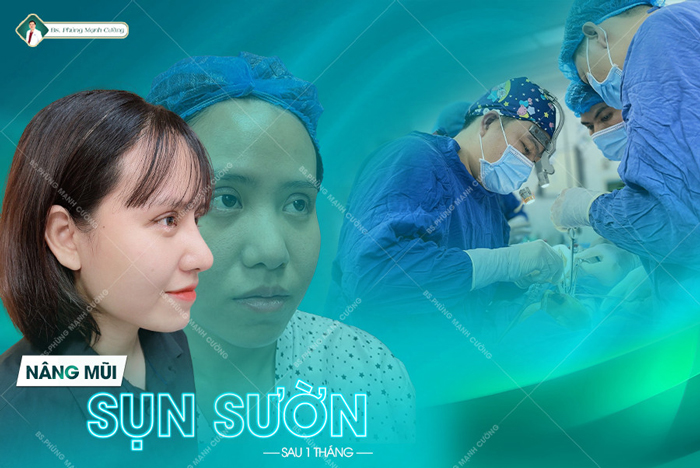 Nâng mũi sụn sườn - Công nghệ đến từ Hàn Quốc