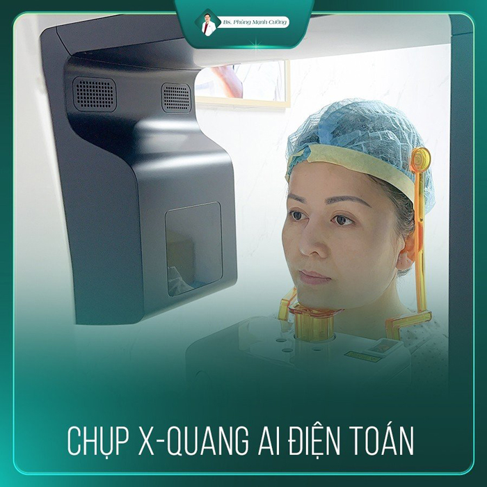 Nâng mũi sụn sườn tại BS Cường được chụp X-quang AI điện toán