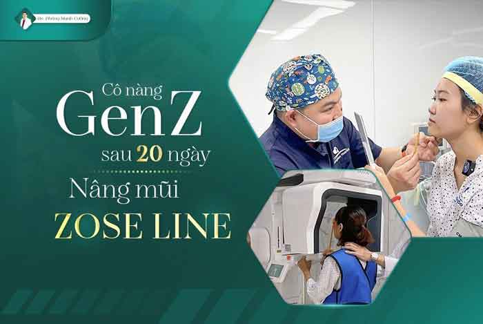 Nâng Mũi Zose-Line Dáng Mũi Thời Thượng Dành Riêng Cho Gen Z