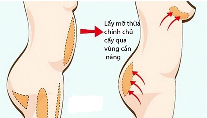 Sử dụng mỡ tự thân để nâng ngực