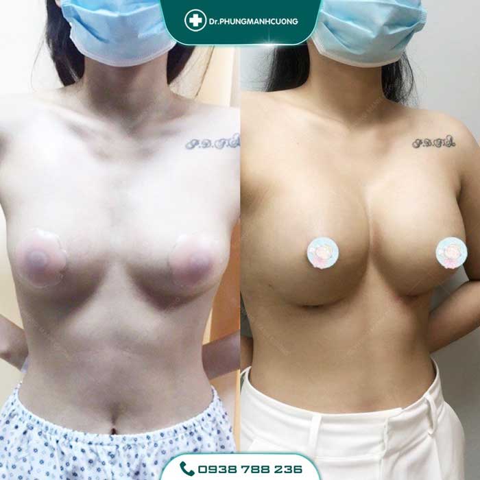 Nâng Ngực Túi Arion Vi Nhám Chuẩn Hàn Tại Việt Nam 37 nang nguc1