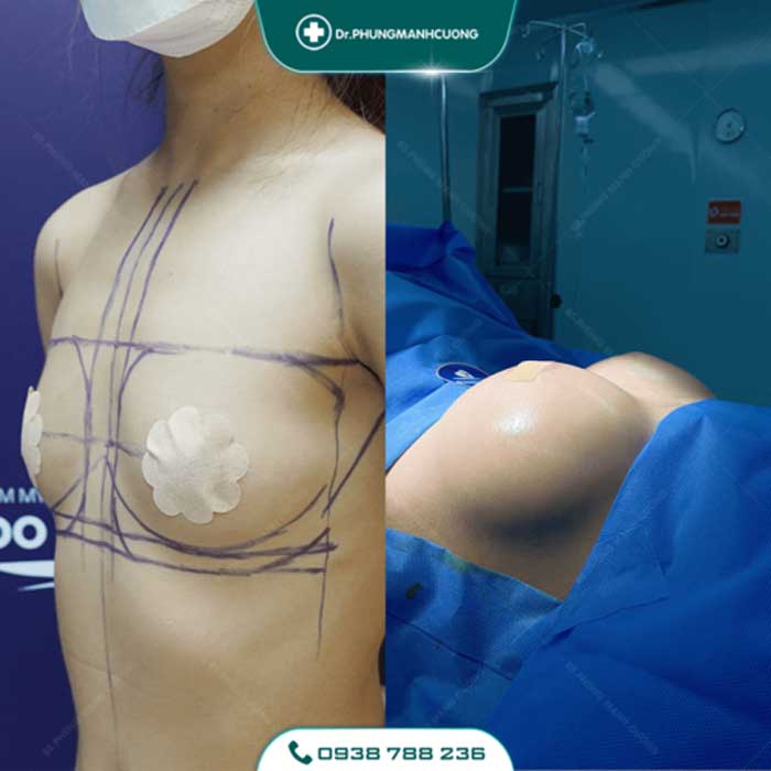 Nâng Ngực Túi Arion Vi Nhám Chuẩn Hàn Tại Việt Nam 27 nang nguc13