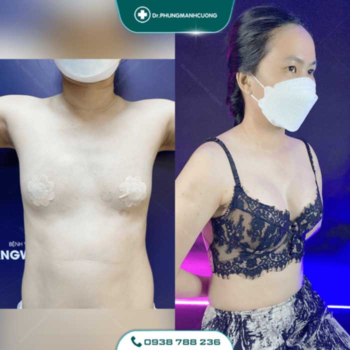 Nâng Ngực Túi Arion Vi Nhám Chuẩn Hàn Tại Việt Nam 26 nang nguc14