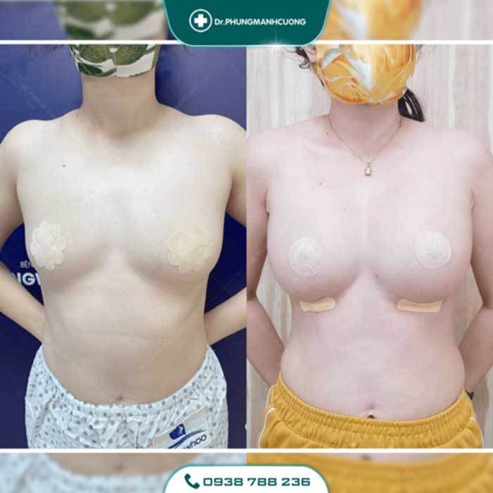 Nâng Ngực Túi Arion Vi Nhám Chuẩn Hàn Tại Việt Nam 25 nang nguc15