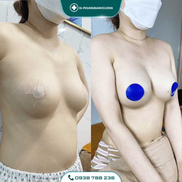 Nâng Ngực Túi Arion Vi Nhám Chuẩn Hàn Tại Việt Nam 24 nang nguc16