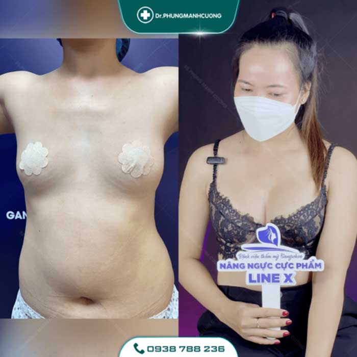 Nâng Ngực Túi Arion Vi Nhám Chuẩn Hàn Tại Việt Nam 36 nang nguc2