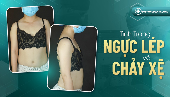 Tại sao nên thực hiện phẫu thuật nâng ngực?