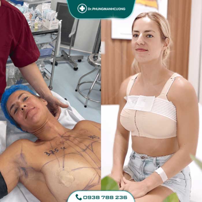 Nâng Ngực Túi Arion Vi Nhám Chuẩn Hàn Tại Việt Nam 35 nang nguc3