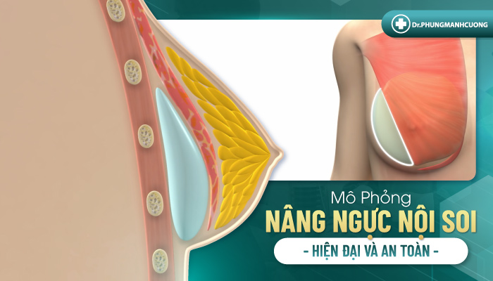 Phẫu thuật nâng ngực là gì?