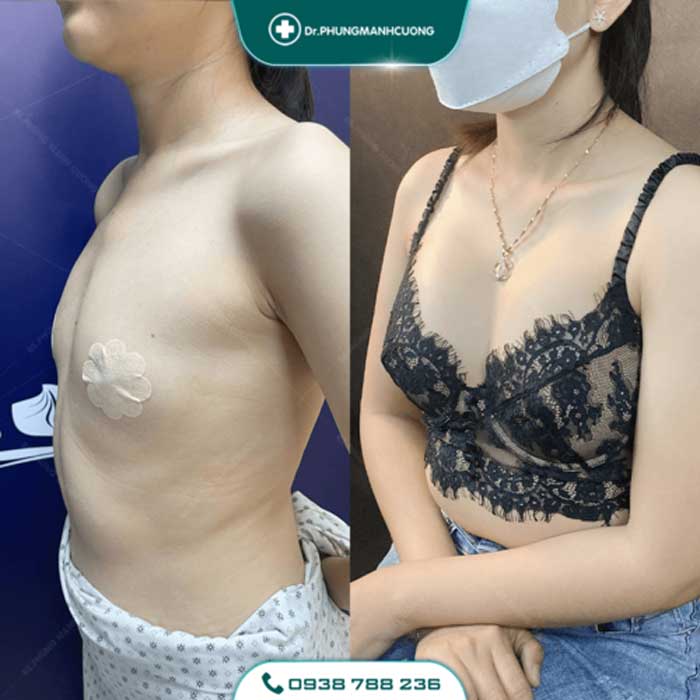 Nâng Ngực Túi Arion Vi Nhám Chuẩn Hàn Tại Việt Nam 34 nang nguc5