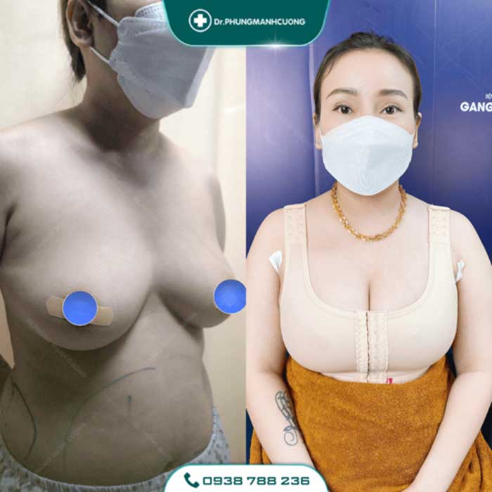 Nâng Ngực Túi Arion Vi Nhám Chuẩn Hàn Tại Việt Nam 32 nang nguc7