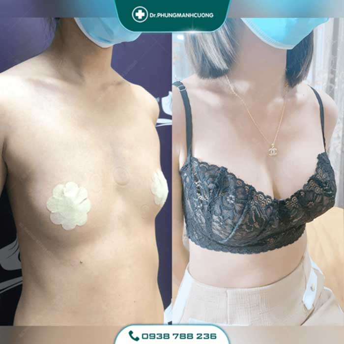 Nâng Ngực Túi Arion Vi Nhám Chuẩn Hàn Tại Việt Nam 31 nang nguc8