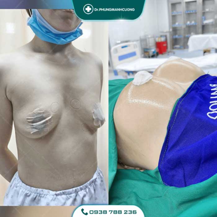 Nâng Ngực Túi Arion Vi Nhám Chuẩn Hàn Tại Việt Nam 30 nang nguc9