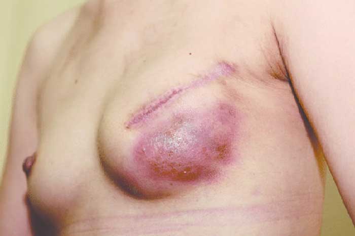 Ngực bị nhiễm trùng, hoại tử 