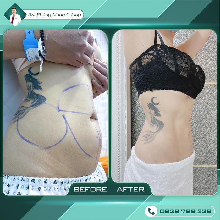 iảm Béo, Giảm Mỡ Toàn Thân: Vùng Bụng, Bụng Dưới, Bắp Tay