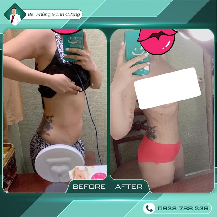 Lipo Minfat: Hút Mỡ Bằng Công Nghệ Mới, An Toàn Hiện Nay 16 Lipo Minfat: Hút Mỡ Bằng Công Nghệ An Toàn Nhất Hiện Nay