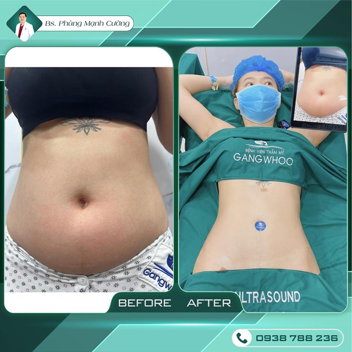 Giảm Béo Bằng Công Nghệ Mới - Lipo Thin Max 22 pmc 11