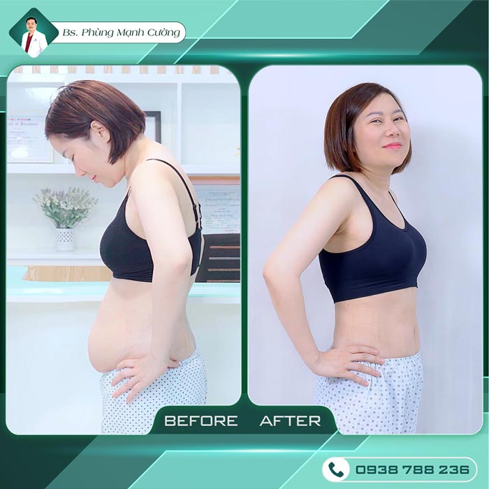 Giảm Béo Bằng Công Nghệ Mới - Lipo Thin Max 26 pmc 5