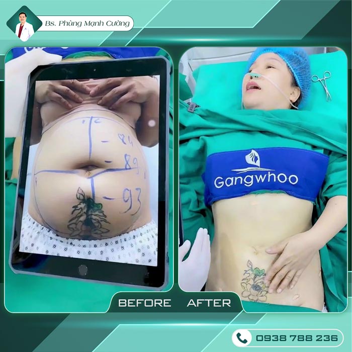 Giảm Béo Bằng Công Nghệ Mới - Lipo Thin Max 24 Giảm mỡ hạn chế phẫu thuật