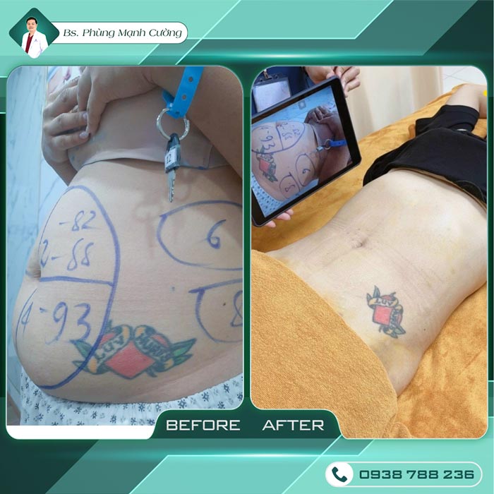 Lipo Minfat: Hút Mỡ Bằng Công Nghệ Mới, An Toàn Hiện Nay 18 Lipo Minfat: Hút Mỡ Bằng Công Nghệ Uy Tín Nhất Hiện Nay