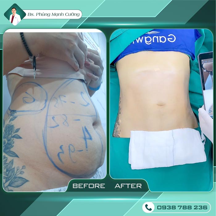 Lipo Minfat: Hút Mỡ Bằng Công Nghệ Mới, An Toàn Hiện Nay 17 Lipo Minfat: Hút Mỡ Bằng Công Nghệ Hiệu Quả Nhất Hiện Nay