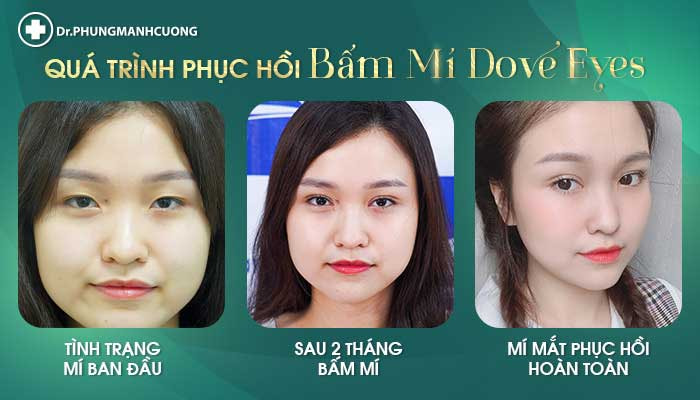Quý trình hồi phục sau bấm mí Dove Eyes