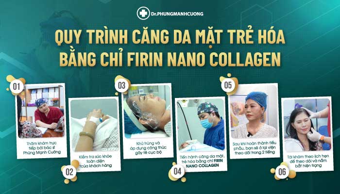 Căng Da Mặt Trẻ Hóa Bằng Chỉ Firin Nano Collagen Lấy Lại Thanh Xuân, Xóa Mờ Nếp Nhăn 22 Quy trình thực hiện căng da mặt trẻ hóa bằng chỉ Firrin Nano Collagen tại BS Cường