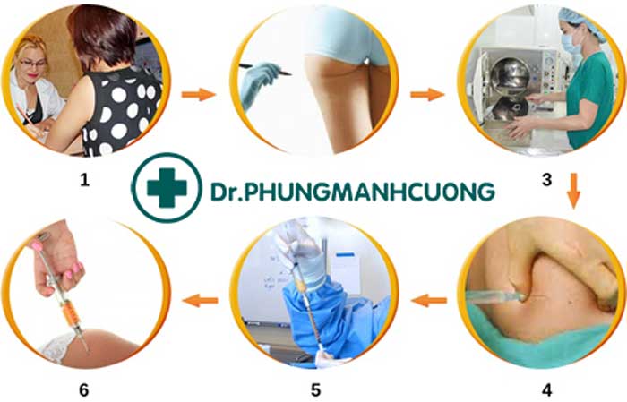 Nâng Mông Bằng Mỡ Tự Thân Cho Vòng 3 Căng Đầy, Mềm Mại 17 Quy trình thực hiện nâng mông bằng mỡ tự thân chuẩn an toàn