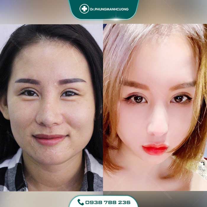 Chuyên Gia Sửa Mí Mắt Hỏng - Giải Cứu Thảm Họa Thẩm Mỹ 29 sua mat hong1 1