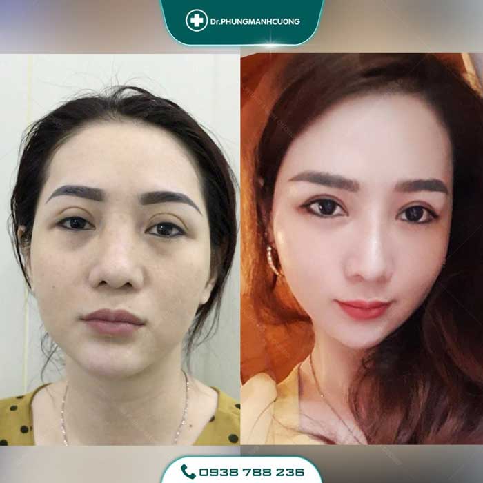 Chuyên Gia Sửa Mí Mắt Hỏng - Giải Cứu Thảm Họa Thẩm Mỹ 28 sua mat hong2 1